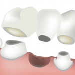 pont dental