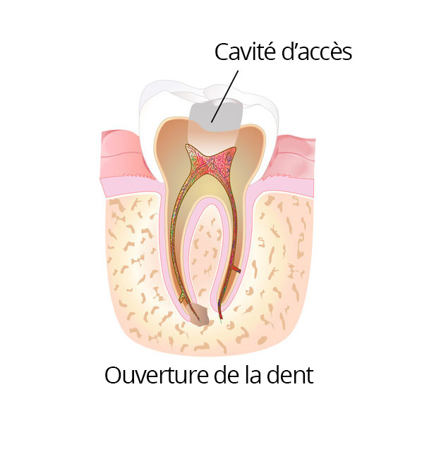 root_canal_02_fr