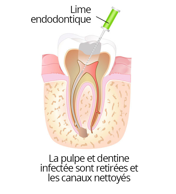 root_canal_03_fr